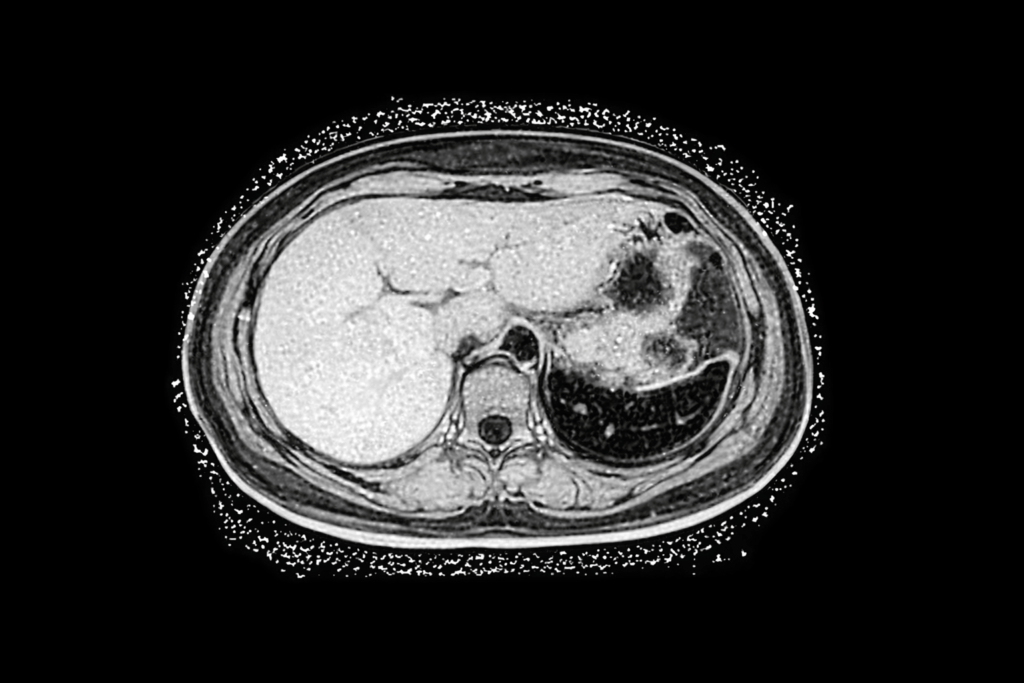 Black and white MRI scan of fatty liver showing increased liver fat content and metabolic dysfunction, mitochondrial health, Mitozz, FMG Health Sciences, (-)-epicatechin