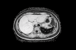 Black and white MRI scan of fatty liver showing increased liver fat content and metabolic dysfunction, mitochondrial health, Mitozz, FMG Health Sciences, (-)-epicatechin