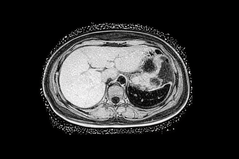 Black and white MRI scan of fatty liver showing increased liver fat content and metabolic dysfunction, mitochondrial health, Mitozz, FMG Health Sciences, (-)-epicatechin