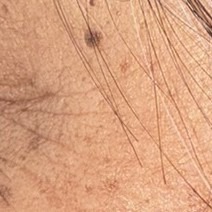 Close-up facial skin texture after consistent use of the epicatechin serum.