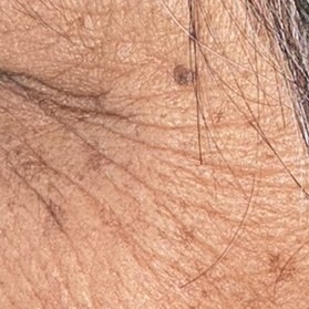 Close-up facial skin texture before use of the epicatechin serum.