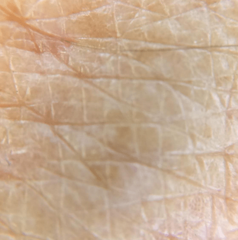 Close-up skin image after 30 days, comparison one.