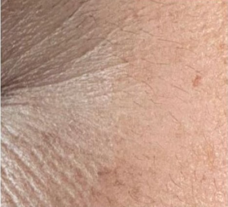 Close-up skin image before the 30-day period, comparison two.