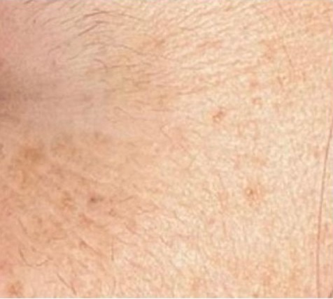 Close-up skin image after 30 days, comparison two.