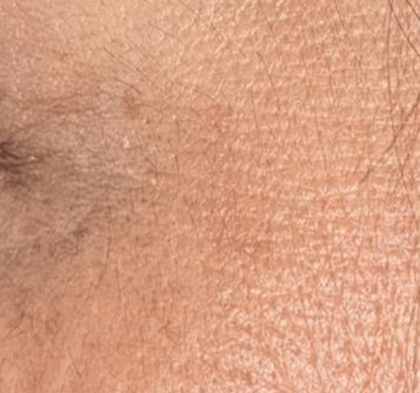 Skin after using Mitozz RS, comparison 1.