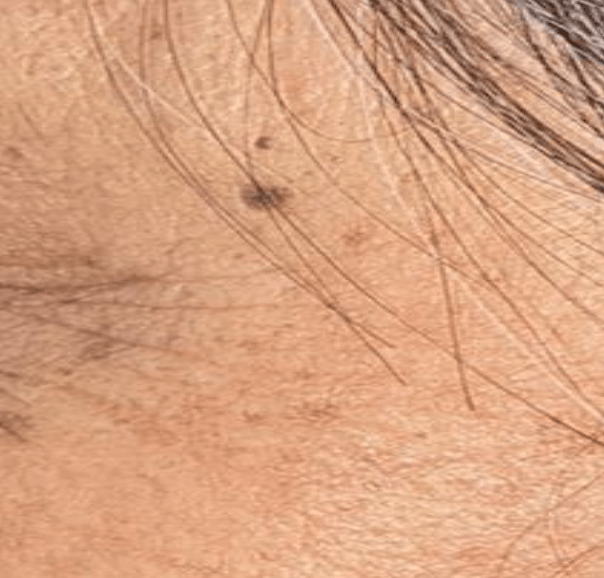 Skin after using Mitozz RS, comparison 2.