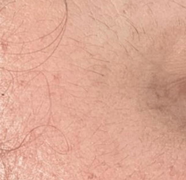 Skin after using Mitozz RS, comparison 3.