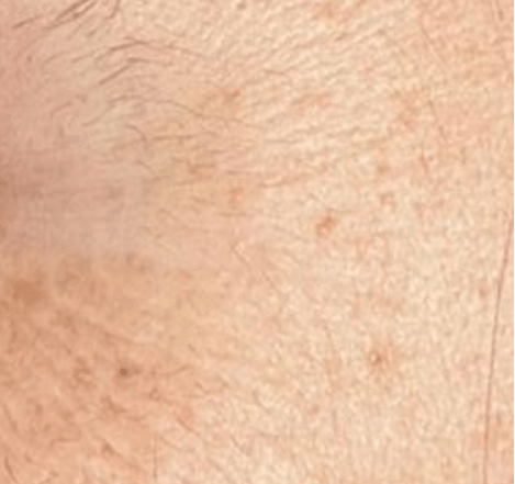 Skin after using Mitozz RS, comparison 4.