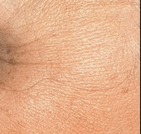 Skin after using Mitozz RS, comparison 5.