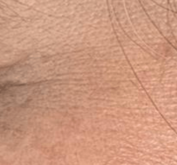Skin before using Mitozz RS, comparison 1.