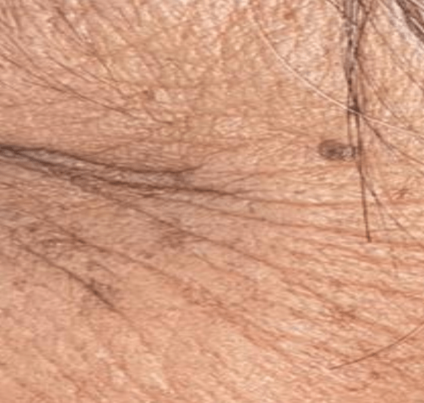 Skin before using Mitozz RS, comparison 2.