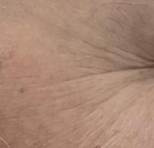 Skin before using Mitozz RS, comparison 3.