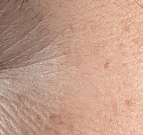 Skin before using Mitozz RS, comparison 4.