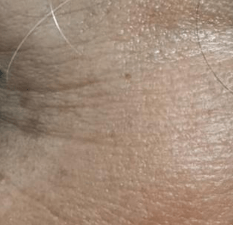Skin before using Mitozz RS, comparison 5.
